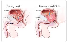 dimensiunile normale ale prostatei prostatita în ayurveda